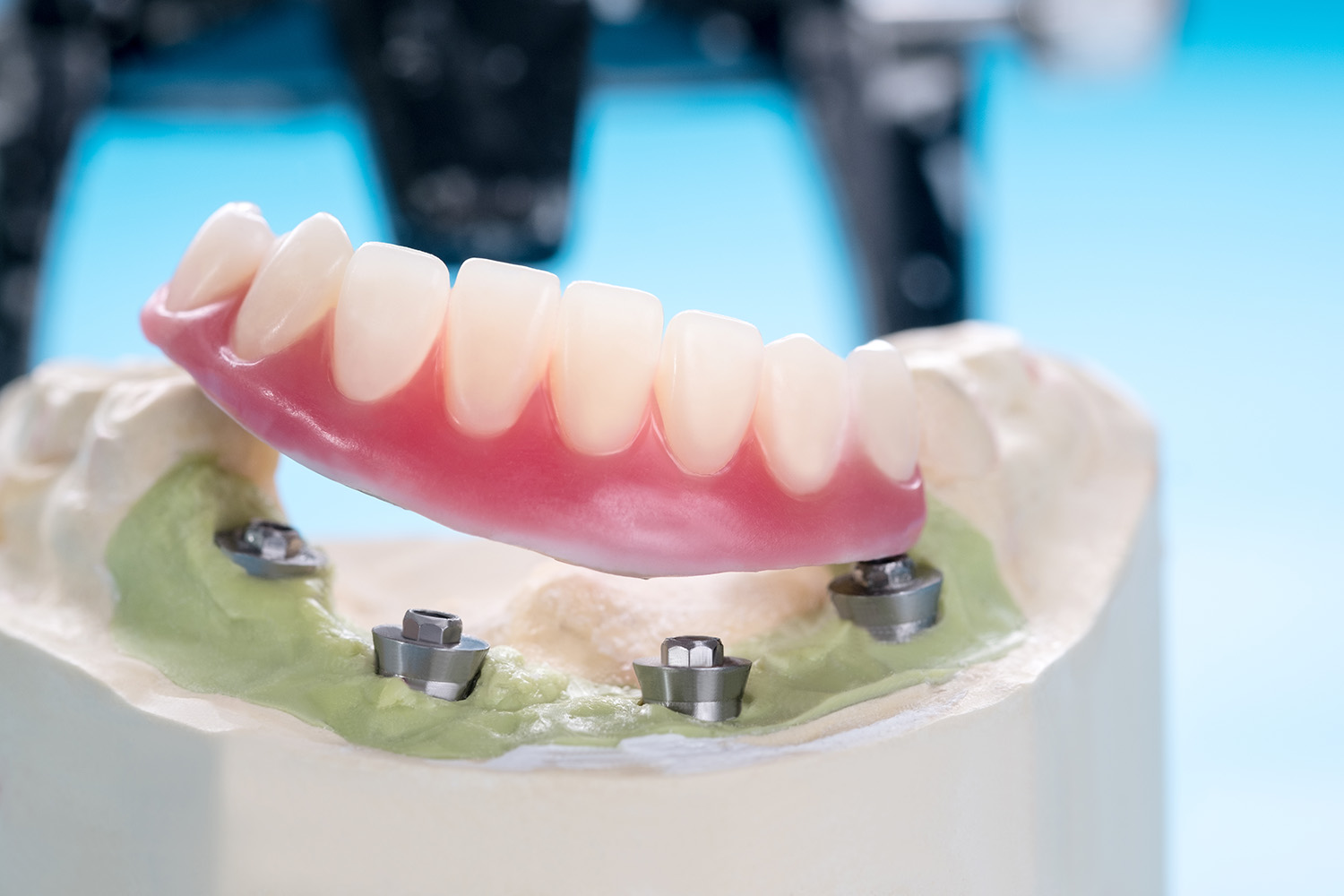 All In One Solution All-on-4 Implants - West Perth Cosmetic & Emergency Dental