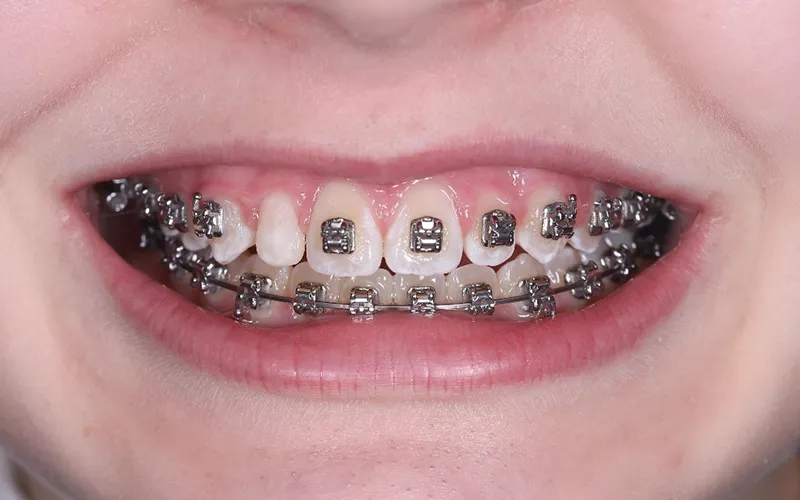 westperth-case-study-peg lateral incisor-banner peg lateral incisor